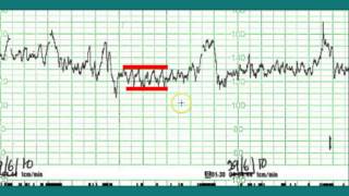 Ctg interpretation  Normal CTG [upl. by Laurance674]