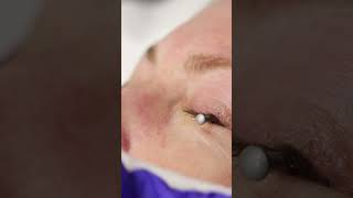 Eye Wrinkles Treatment with Ablative Co2 Laser [upl. by Fin]