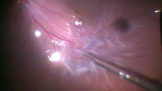 Vitrectomy for Retinal Detachment with Macular pucker  Retinal Detachment  Dr Manish Nagpal [upl. by Ray355]