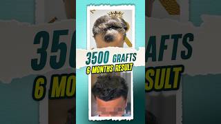 3500 Grafts Hair Transplant  Hair Tutorial hairtransplant hairtutorial hair shorts [upl. by Stubbs]