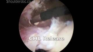 Cuff Releases  anterior and CHL  viewing from posterior and working from lateral  labelsmov [upl. by Anilas]