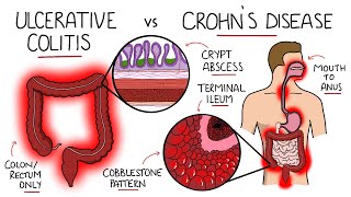 Inflammatory Bowel Disease  Ulcerative Colitis v Crohns Disease With Histology amp Manifestations [upl. by Per923]