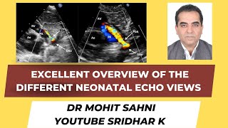 Neonatal echoan excellent overview of how to obtain the basic views Dr Mohit Sahni pocus echo [upl. by Anikal]