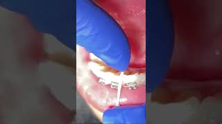 Why did my dentist shave between my teeth IPR Inter Proximal Reduction Tooth Time Family Dentistry [upl. by Michaela259]