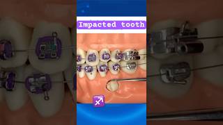 Impacted tooth during Braces [upl. by Xaviera]