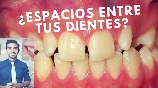 Cómo cerrar los espacios entre los dientes Diastemas dentales [upl. by Ebsen]