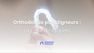 Orthodontie invisible par aligneurs  la pose de taquets [upl. by Concordia]