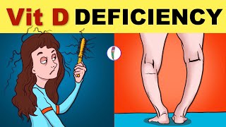 Vitamin D Deficiency  Vitamin D Deficiency Symptoms  Vitamin D Deficiency Rickets  Osteomalacia [upl. by Rosabelle]