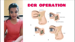 Dacryocystorhinostomy DCRsurgery Dacryocystitis Part 2 A K Khurana [upl. by Onig47]