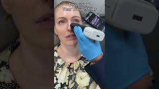 Dissolving Tear Trough Filler  Dr Medispa [upl. by Horlacher]