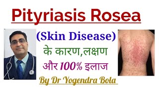 Pityriasis Rosea Skin Disease का CompleteTreatment in Hindi  By Dr Yogendra Bola [upl. by Otrebile]