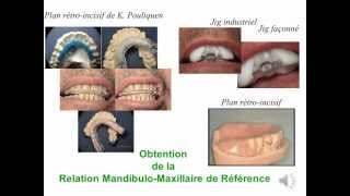 Relation Mandibulo Maxillaire Référence en Prothèse wmv [upl. by Amabil161]