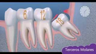 Tema 5 Cirugía Oral Terceros Molares [upl. by Stein]