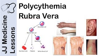 Polycythemia Rubra Vera  Pathophysiology Symptoms Diagnosis and Treatment [upl. by Padegs]