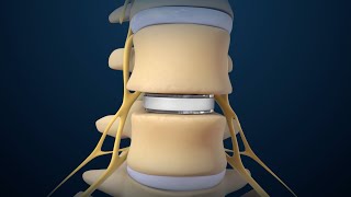 Back Surgery Lumbar Disc Replacement [upl. by Doralin188]