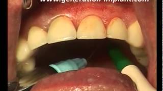 Incisive centrale  extraction implantation  technique flapless [upl. by Acired]