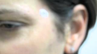 Trattamento angioma con laser NdYAG [upl. by Ytsirhc]