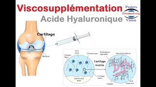 Viscosupplémentation contre larthrose injection intra articulaire dacide hyaluronique [upl. by Ahab653]