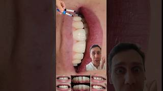 🔴CASO DE FECHAMENTO DE DIASTEMAS  ESPAÇOS EM 4 DENTES REALIZADO COM 2 CORES DE RESINAS dentist [upl. by Enilatan778]