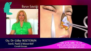 OpDrGülay BOZTOSUN quotBURUN ESTETİĞİ RHİNOPLASTYquot wwwdrgulayboztosuncom [upl. by Hollinger119]