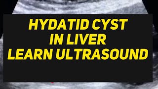 Hydatid Cyst in Liver ultrasound case  learn usg [upl. by Pris]