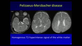 Leukodystrophies and Leukoencephalopaties  Andrea Poretti MD [upl. by Otiragram]