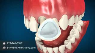 Dental Cap Procedure  Tooth Caps [upl. by Ynneb651]