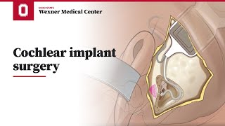 Cochlear implant surgery  Ohio State Medical Center [upl. by Akinahc544]