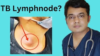 TB Lymphnode Symptoms Diagnosis amp Treatment Tuberculous lymphadeniyis [upl. by Anelaj]