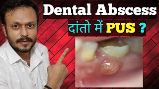 दाँतों में पस फोड़ी से कैसे पाएं छुटकारा  Dental Abscess Treatment in Hindi Types of dental abscess [upl. by Anitnoc]