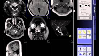 BRAIN MRI NORMAL [upl. by Bora413]