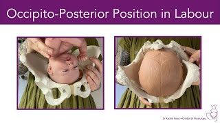 OccipitoPosterior Position BacktoBack in Labour [upl. by Ravahs334]