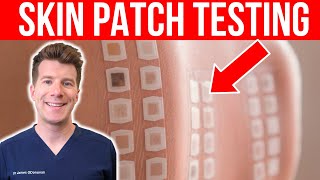 ALLERGY TESTING Doctor explains the Skin Patch Test [upl. by Orten317]