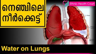 Water on Lungs  നെഞ്ചിലെ നീർക്കെട്ട്  Ethnic Health Court [upl. by Meletius371]