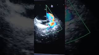 Patent Ductus Arteriosus ECHOCARDIOGRAM cardiacanatomy [upl. by Leunamnauj]