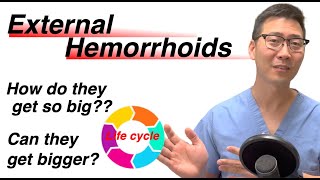 Life cycle of External Hemorrhoids From baby to adult  Dr Chung explains [upl. by Finlay790]