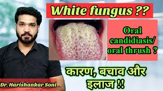 सफेद फंगस  Oral candidiasis  oral thrush  white fungus of mouth causes amp treatment [upl. by Aremus]