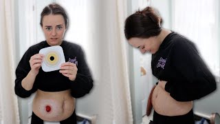 First Trimester Bag Change  11 Weeks Pregnant  Lets Talk IBD [upl. by Amabelle]