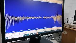 EMG myotonia has characteristic pattern and sound a typical divebomber sound [upl. by Shelby]