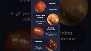 Acute Otitis Media Otoscopy [upl. by Julissa]