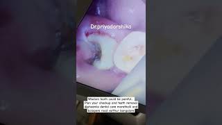 drpriyadarshika phoeniixdentalcare dentalclinic wisdomteethremoval wisdomtoothextraction [upl. by Aissilem]