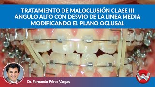 Tratamiento de Maloclusión Clase III Ángulo alto Desvío de línea media cambiando el plano oclusal [upl. by Strephonn]