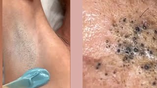 Ingrown hair  Ingrown hair removal  Pimple popping [upl. by Noiek215]