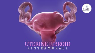 Uterine fibroids 5 signs you should never ignore  Treatment Options for Uterine Fibroids [upl. by Adnauqahs]