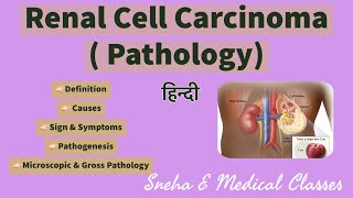 Renal Cell Carcinoma  Pathology  Hindi [upl. by Ymmit]