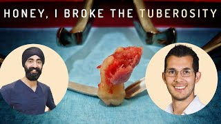 How To Manage a Maxillary Tuberosity Fracture  Oral Surgery Complications [upl. by Begga]