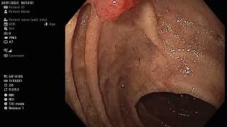 Stomach and Duodenum check up Gastroscopy 2023 01 20 [upl. by Curkell]