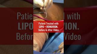 Amazing Patient Results after Liposuction amp Renuvion [upl. by Tat]