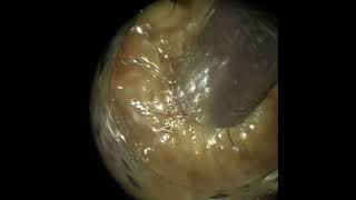 258  Tonnes of Ear Wax Extracted from Patient’s Right Ear using the WAXscope®️ [upl. by Ikram]