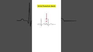 Premature Atrial Contractions Atrial Couplets medicine doctor cardiology medicalstudent ecg [upl. by Adnek448]